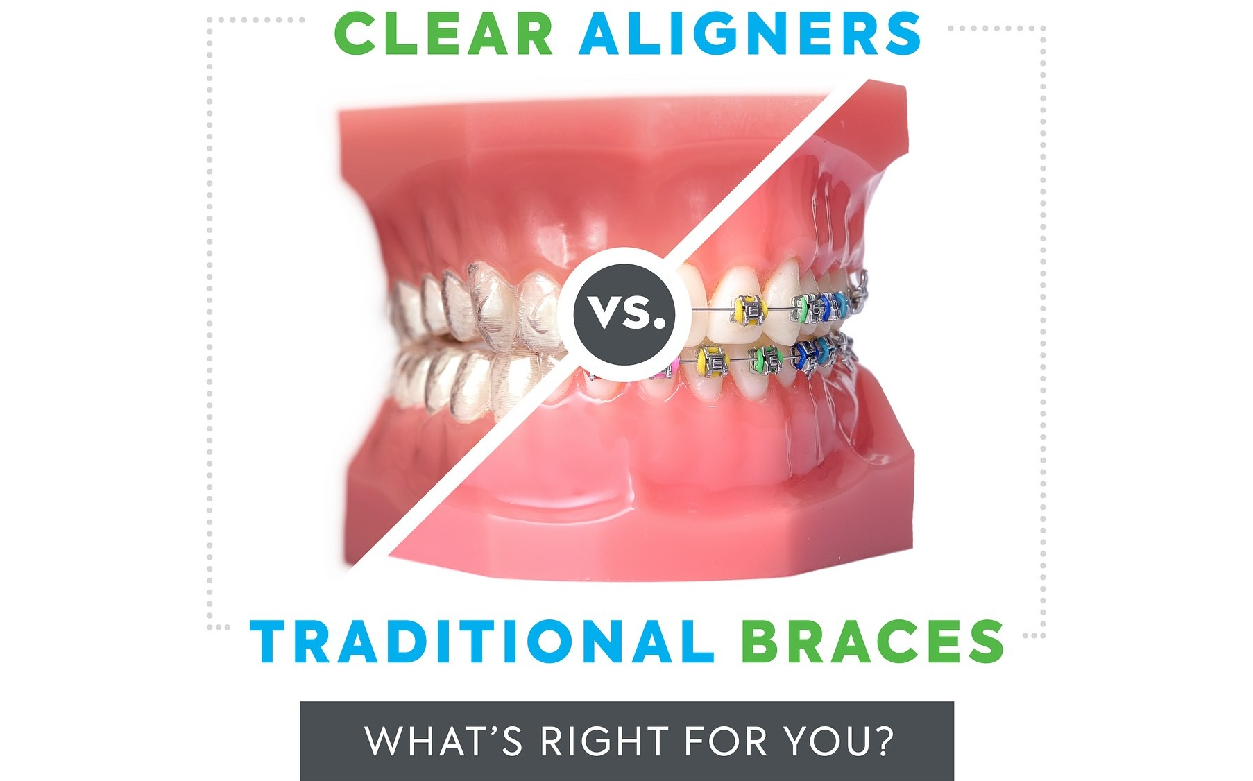 Affordable Invisalign clear aligners and traditional braces in Steele Creek near Charlotte, NC.